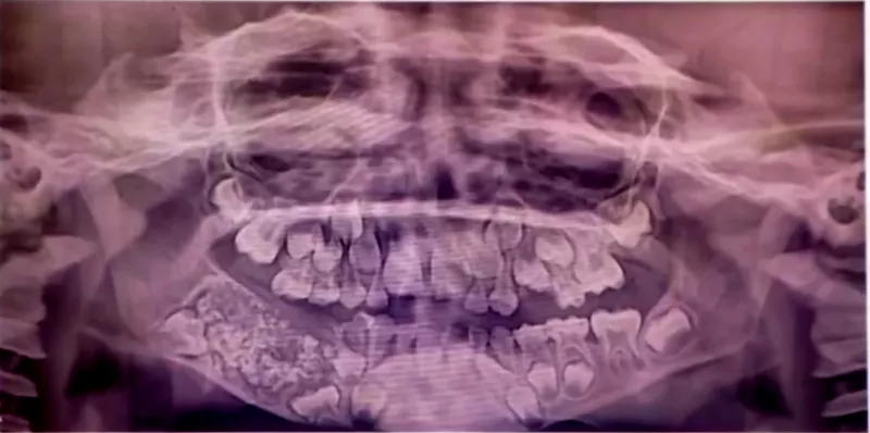 Előkerült a röntgenfelvétel is, ami az orvosokat is megdöbbentette, amikor először meglátták.