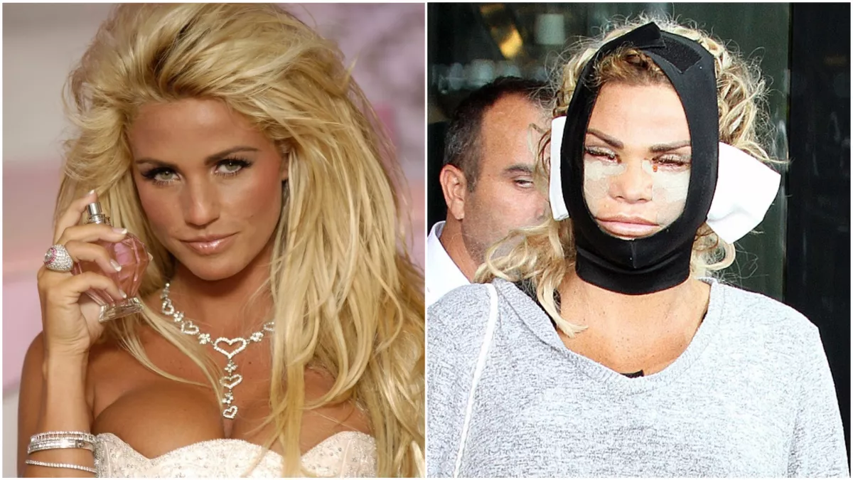 Élő szörnyeteggé plasztikázták az egykori sztármodellt! - Így néz ki most - Fotók 