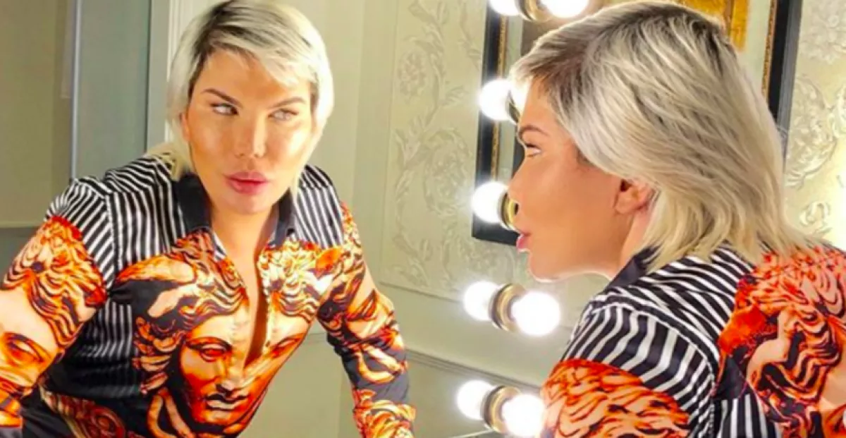 Műteni kell! Szétesett az orra az élő Ken babának - Fotók