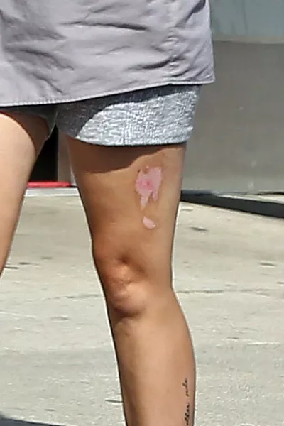 A combján pedig egy hatalmas, tenyérni seb éktelenkedik.. Szakértők szerint égési nyomokra utal. Szegény, még így, 33 évesen nem lennek késő új életet kezdenie