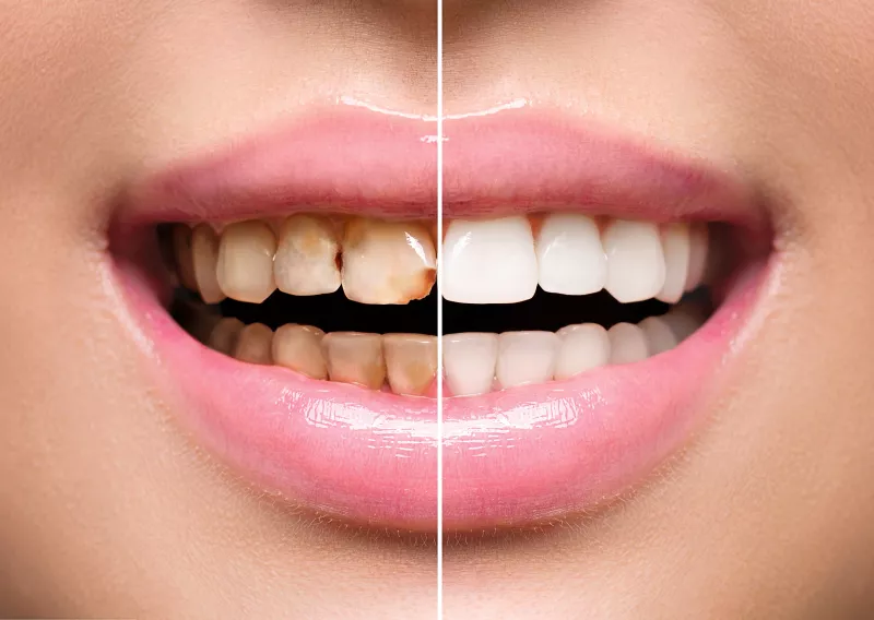 FOGAK. Sajnos a fogaink az évek múlásával sötétebbek lesznek, besárgulnak. Egy fehér fogsor akár tíz évet is fiatalíthat a viselőjén, érdemes megcsináltatni.