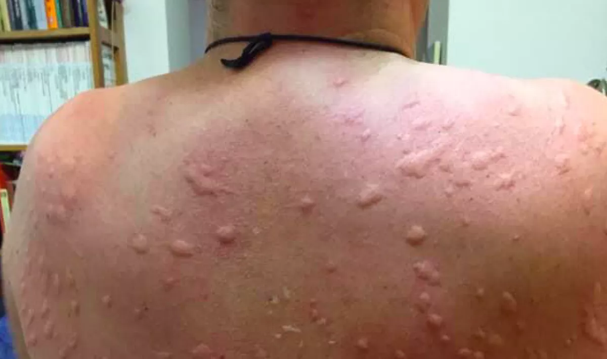 Fél órára ment ki Zoli Vecsésen, a szúnyogok alaposan elbántak vele - Fotók