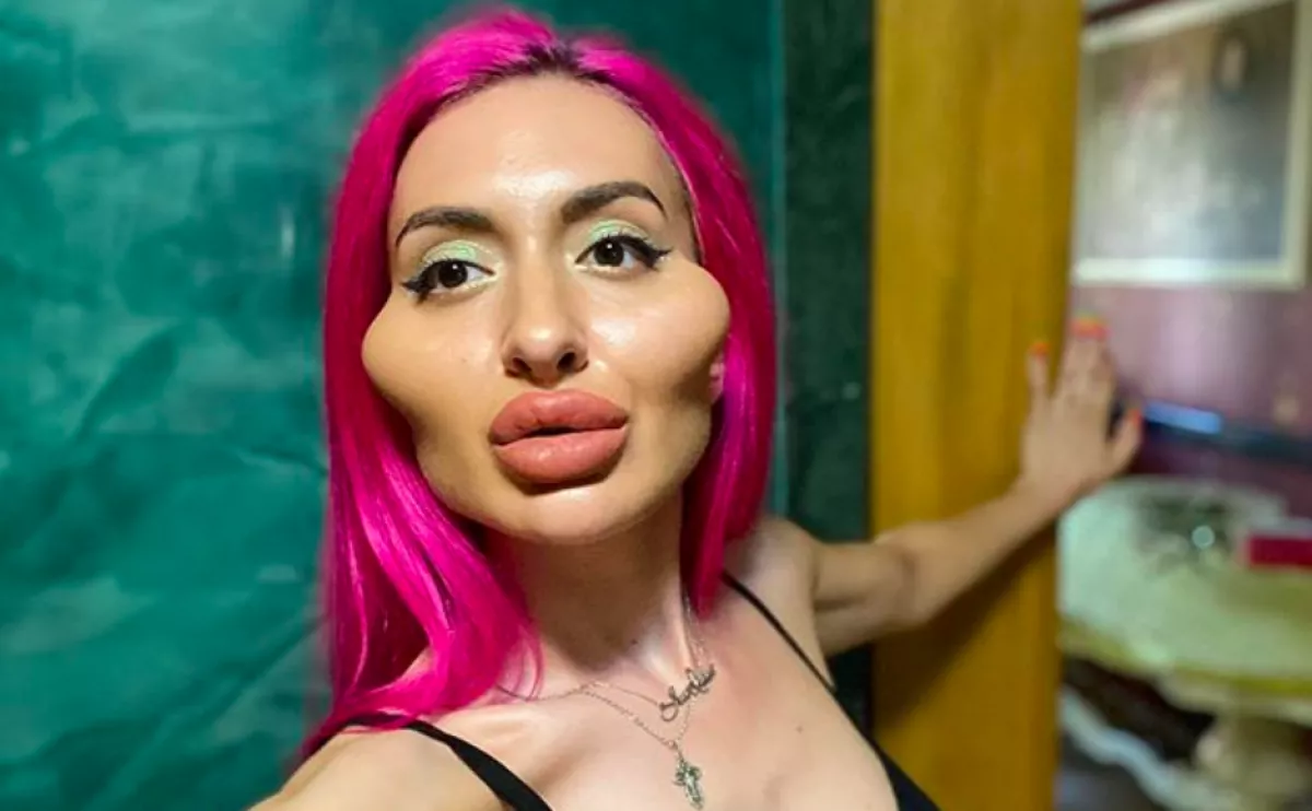 Nagynak találta az orrát, házilag eszkábált ilyen arcot magának az Insta-modell - Fotók