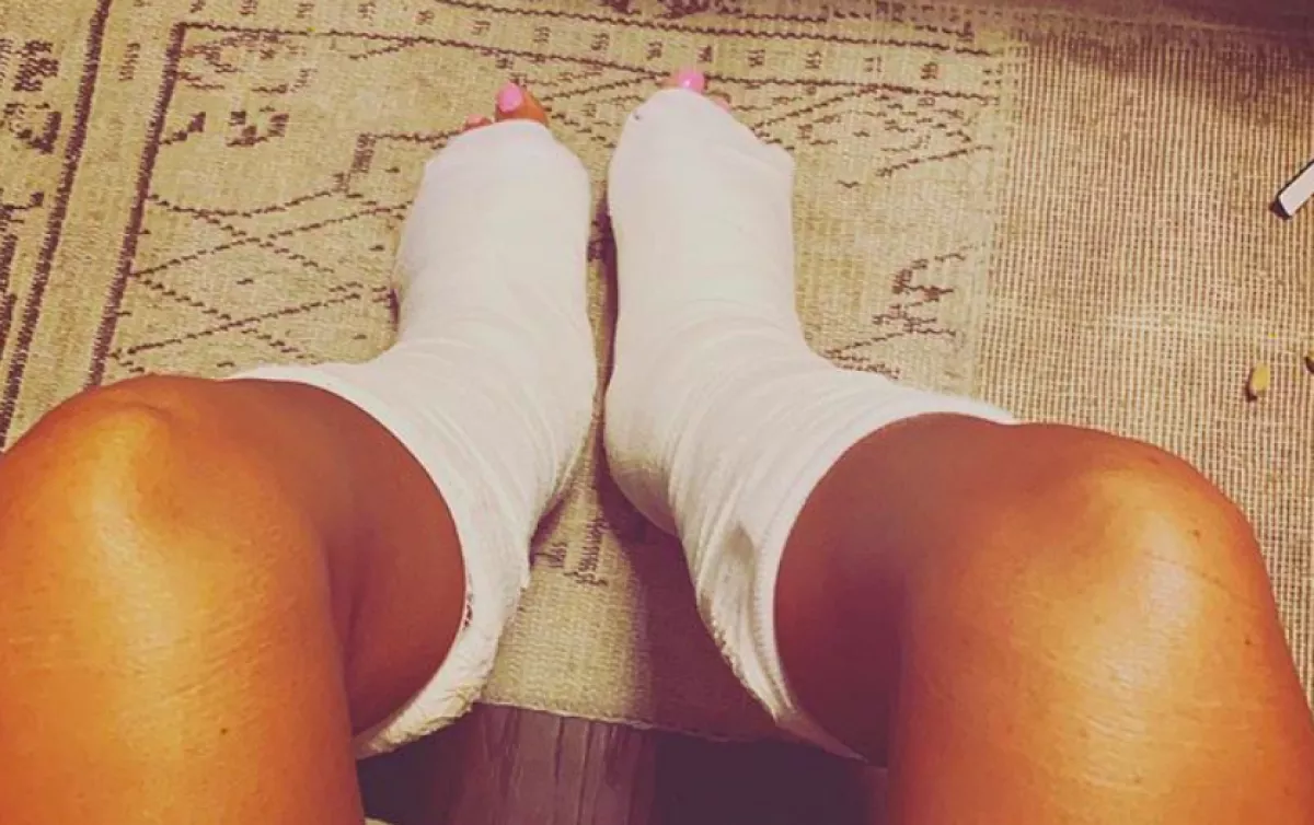 Műteni kell! Mindkét lába eltört a sztármodellnek a nyaralásán! - Fotók