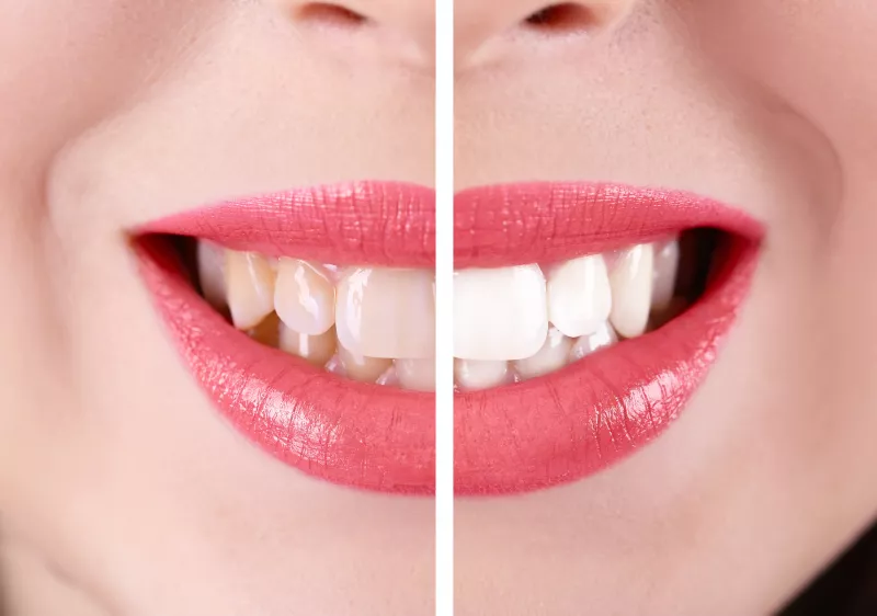 FOGFEHÉRÍTÉS. A fehér fogaknak köszönhetően azonnal fiatalabbnak tűnünk. A fehérítő kezelésekkel és fogrkémekkel hosszútávon éveket nyerhetünk - már, ami a látszatot illeti.