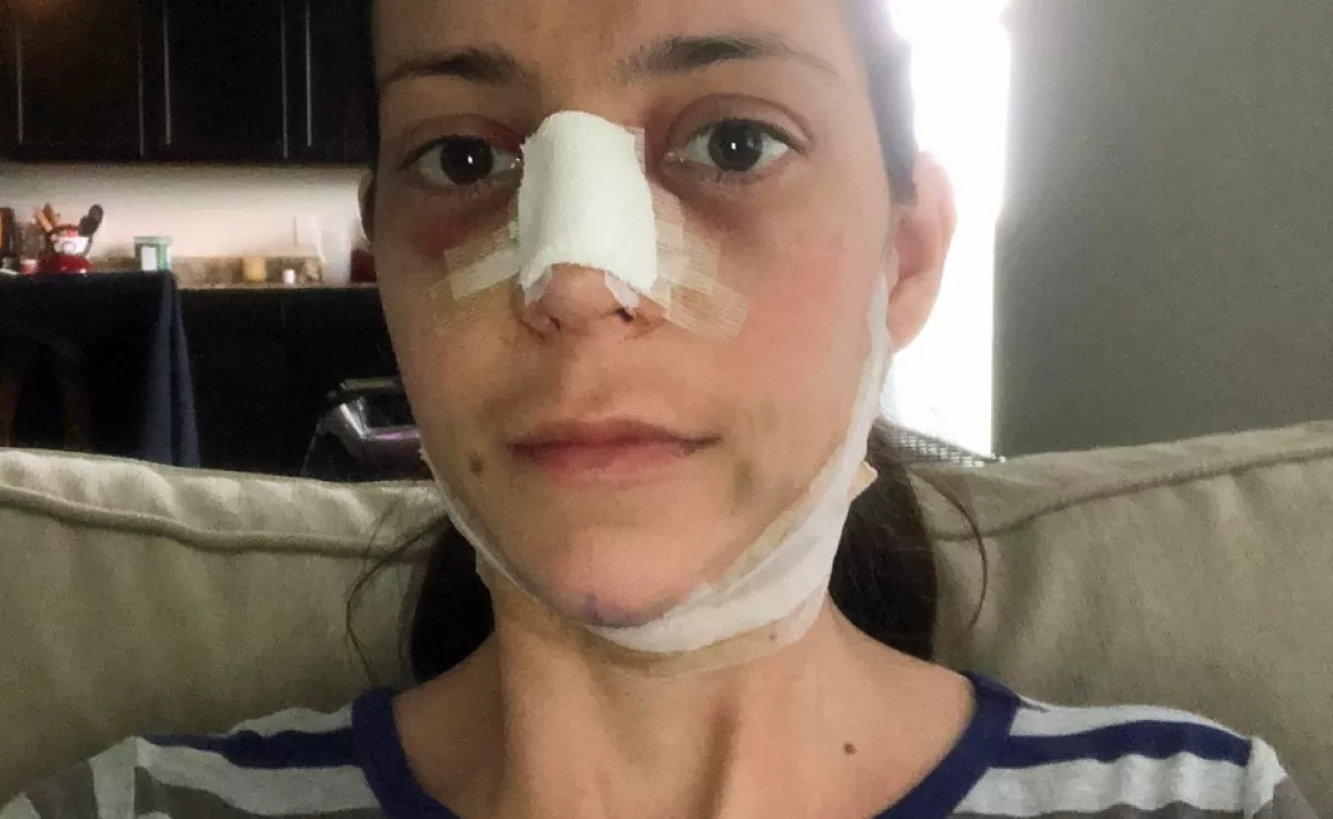 7 millióért operáltatta magát Meghan Markle-é ez a 3 gyerekes anyuka - Fotók