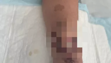 Orvosi csoda: a karján növesztett új orrot magának egy nő egy 3D nyomtatóval - Fotók