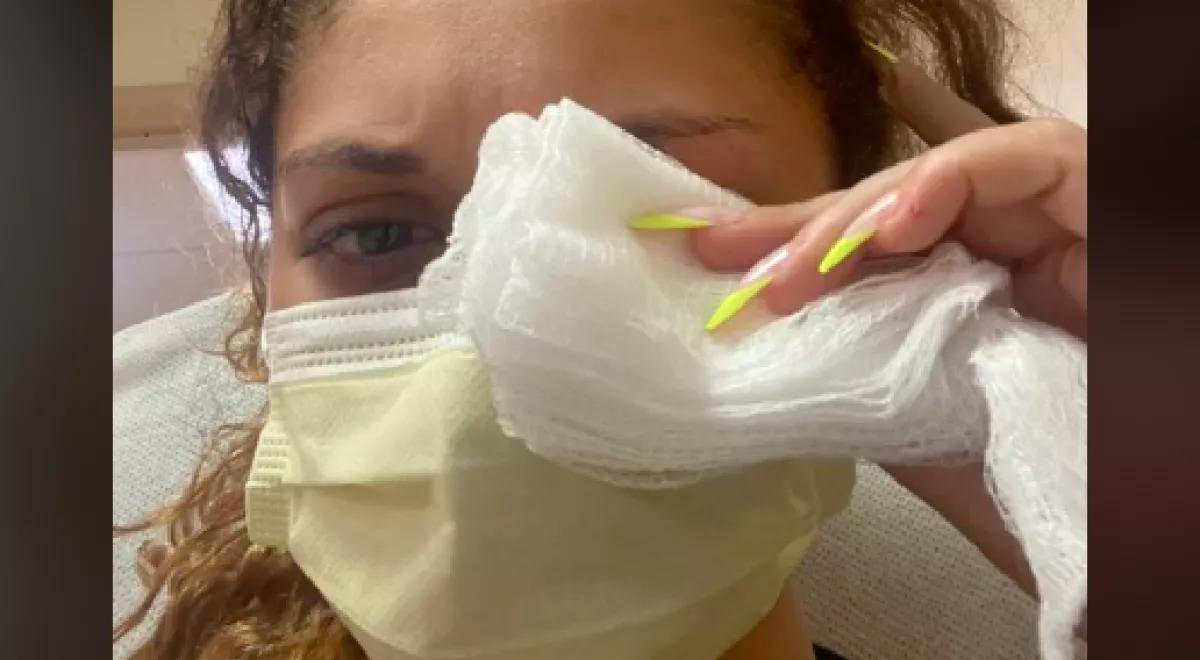 Horror: szemcsepp helyett pillanatragasztót nyomott a szemébe, így van most - Videó