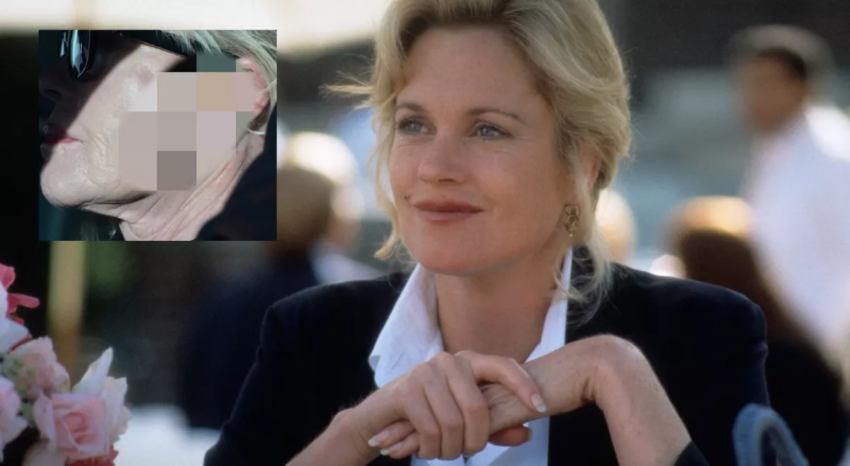 Bőrrákkal diagnosztizálták, aggasztó sebbel az arcán fotózták le Melanie Griffith-et - Fotók