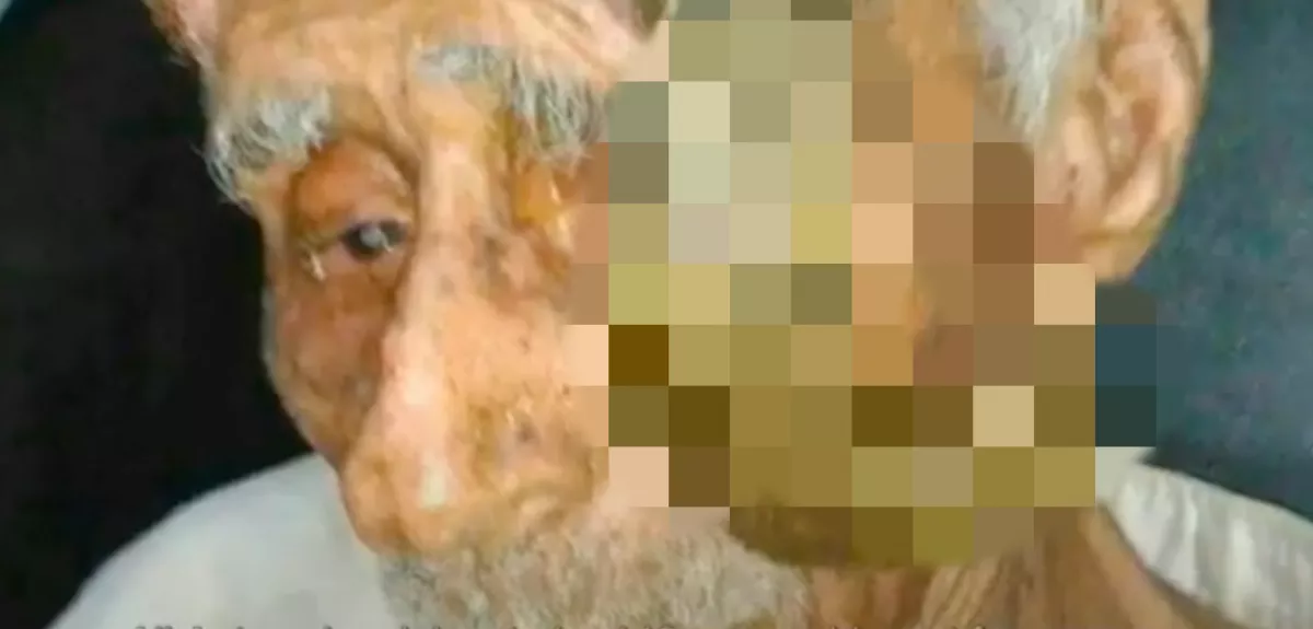 Meghalt a férfi, akinek 100 éves korában szarvai nőttek - Családja szörnyű dolgot gyanít - Fotók