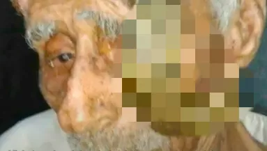 Meghalt a férfi, akinek 100 éves korában szarvai nőttek - Családja szörnyű dolgot gyanít - Fotók