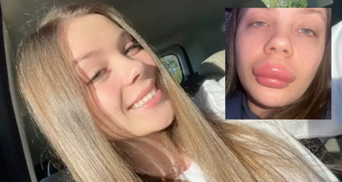 Telt ajkakat akart a 18 éves Emma, a végeredmény nem csak a pasiját sokkolta - Fotók