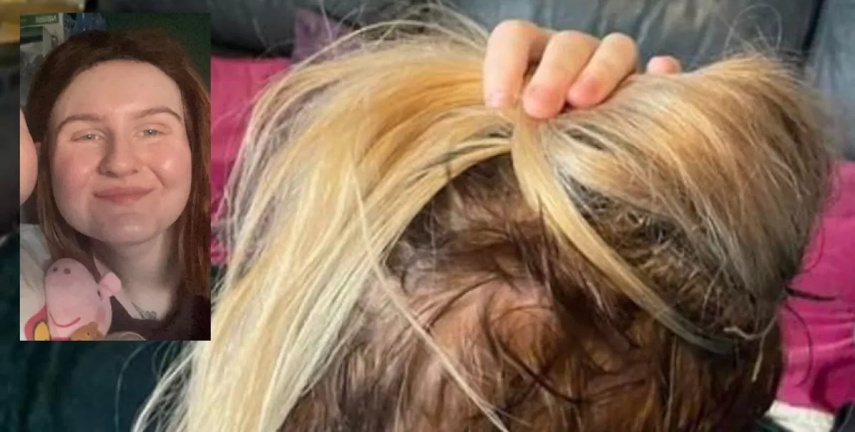 Sokkoló képek: egy szál haja sem maradt a hajhosszabbítás után a fiatal anyukának - Fotók