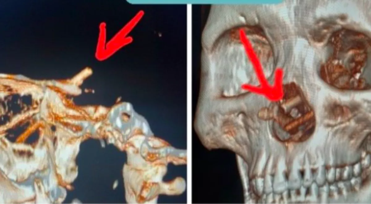 Erős fejfájásra panaszkodott a férfi: amit az orvosok az orrában találtak, attól elállt a szavuk - Fotók