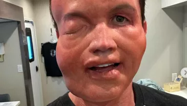 "Enyhe allergiás reakció" - Felismered így ezt a Hollywood-i sztárt? 