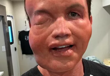 "Enyhe allergiás reakció" - Felismered így ezt a Hollywood-i sztárt? 