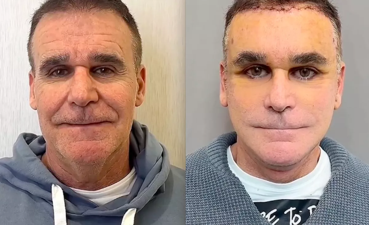 Előtte-utána: Dr. Kim arcfelvarrós videói letarolják a Tik-Tok-ot