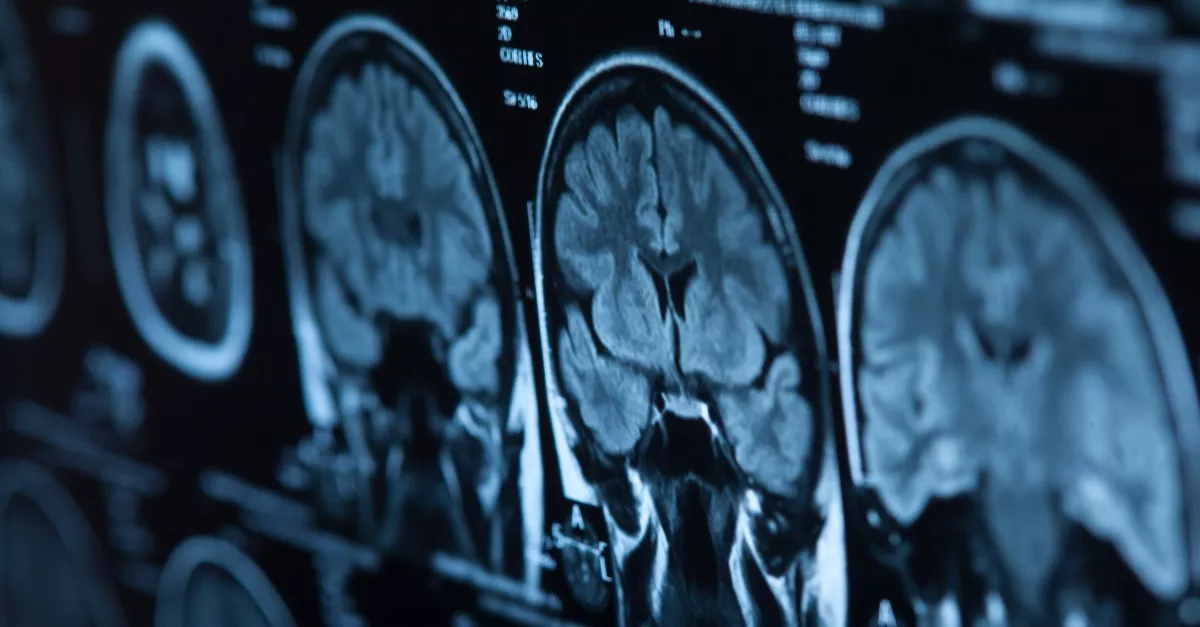 Lárvák voltak a férfi agyában: elsősorban a reggelije a felelős ezért