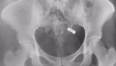 Lenyelte a gyógyszereit a nő: és véletlenül mást is - Videó