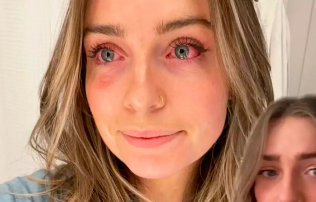 Hónapokig mérgezte magát? Rájött a nő a durva kiütéseinek az okára - Videó