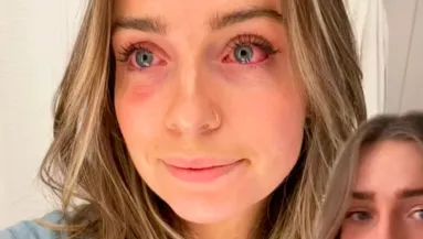 Hónapokig mérgezte magát? Rájött a nő a durva kiütéseinek az okára - Videó