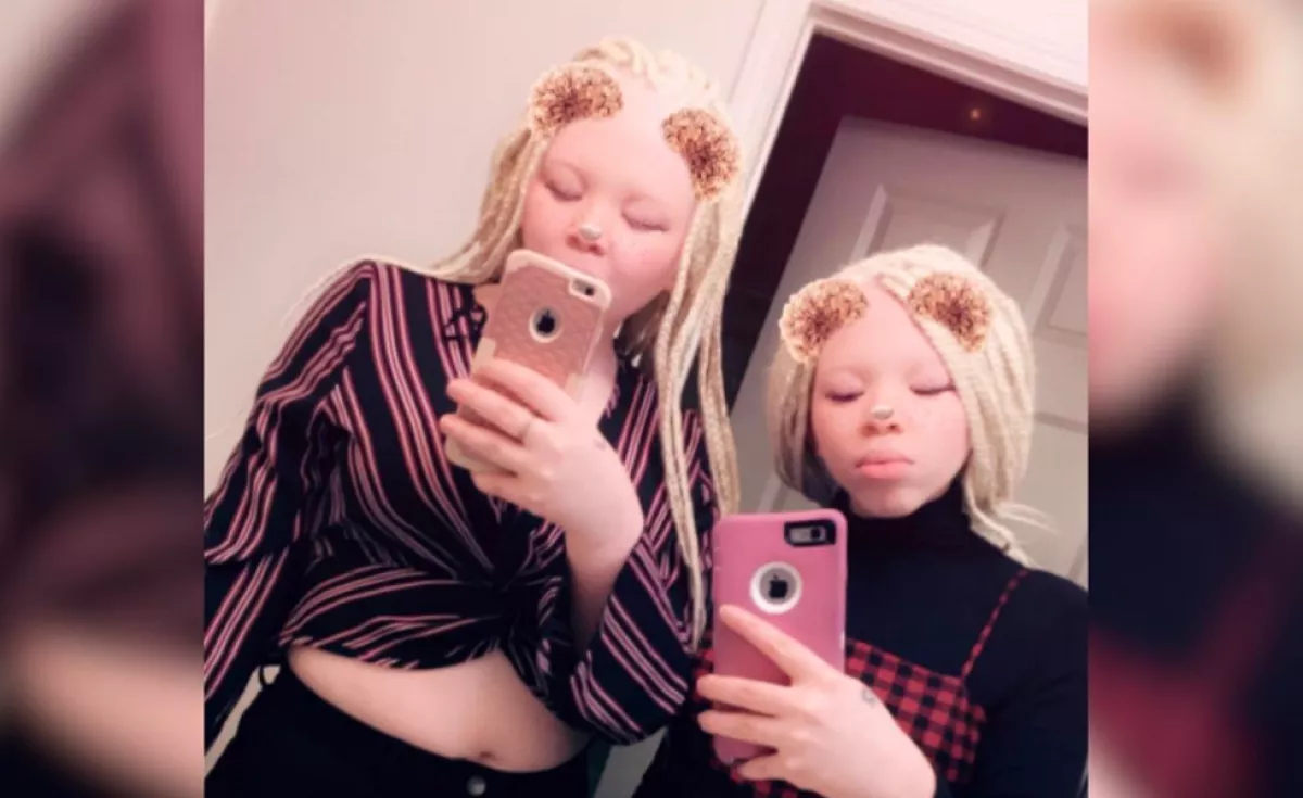 Hihetetlen ritka: az ikerlányok mindketten albínók - Fotók