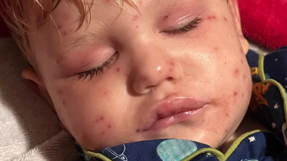 150-szer csíptek meg darazsak egy 2 éves kisfiút: leálltak a szervei - Fotók