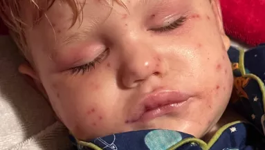 150-szer csíptek meg darazsak egy 2 éves kisfiút: leálltak a szervei - Fotók