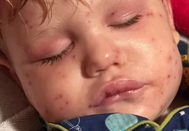 150-szer csíptek meg darazsak egy 2 éves kisfiút: leálltak a szervei - Fotók