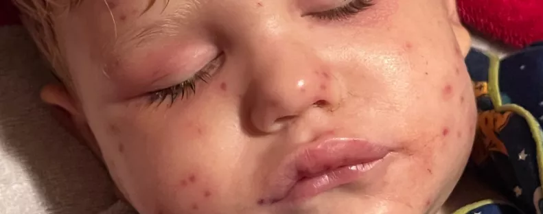 150-szer csíptek meg darazsak egy 2 éves kisfiút: leálltak a szervei - Fotók