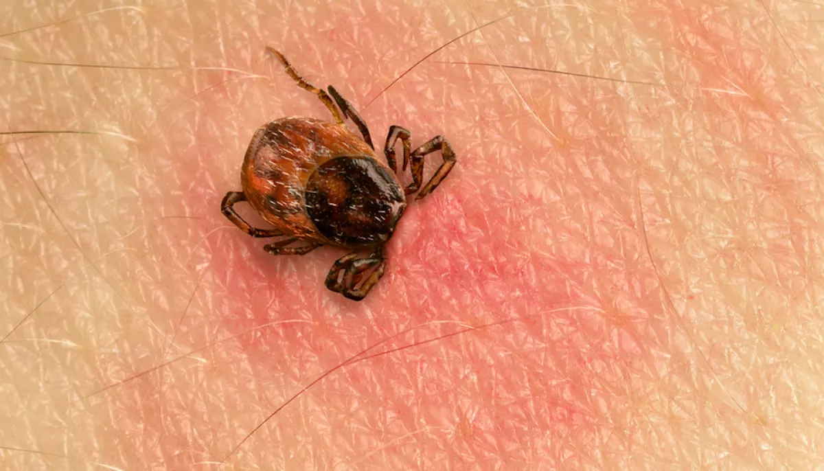 Most érkezett: egy 9 éves kislány kapta el a legsúlyosabb kullancsok által terjesztett fertőzést