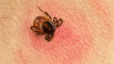 Most érkezett: egy 9 éves kislány kapta el a legsúlyosabb kullancsok által terjesztett fertőzést