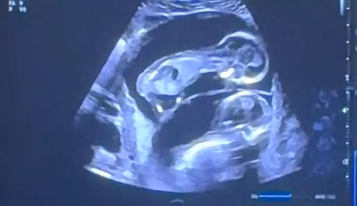 Meglátja a kismama az ultrahangon, mint csinálnak a babái: és nem jut szóhoz - Videó