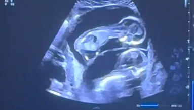 Meglátja a kismama az ultrahangon, mint csinálnak a babái: és nem jut szóhoz - Videó