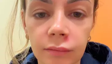 Az arc "halál háromszögében" nyomta ki a pattanását a nő: durva vége lett - Videó 