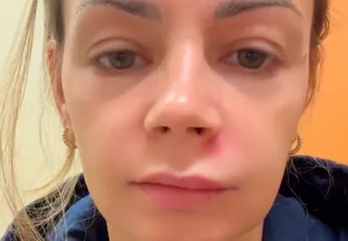 Az arc "halál háromszögében" nyomta ki a pattanását a nő: durva vége lett - Videó 