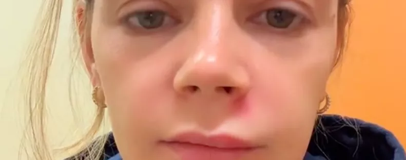 Az arc "halál háromszögében" nyomta ki a pattanását a nő: durva vége lett - Videó 