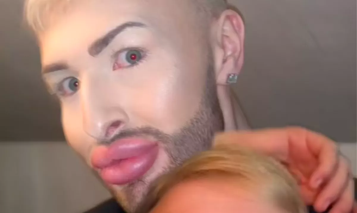 Éveken át botoxoltatta az arcát a férfi - így néz ki ma - Videó