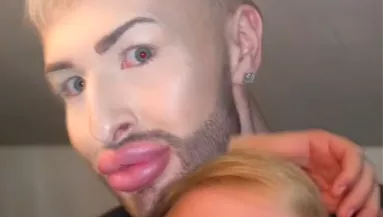 Éveken át botoxoltatta az arcát a férfi - így néz ki ma - Videó