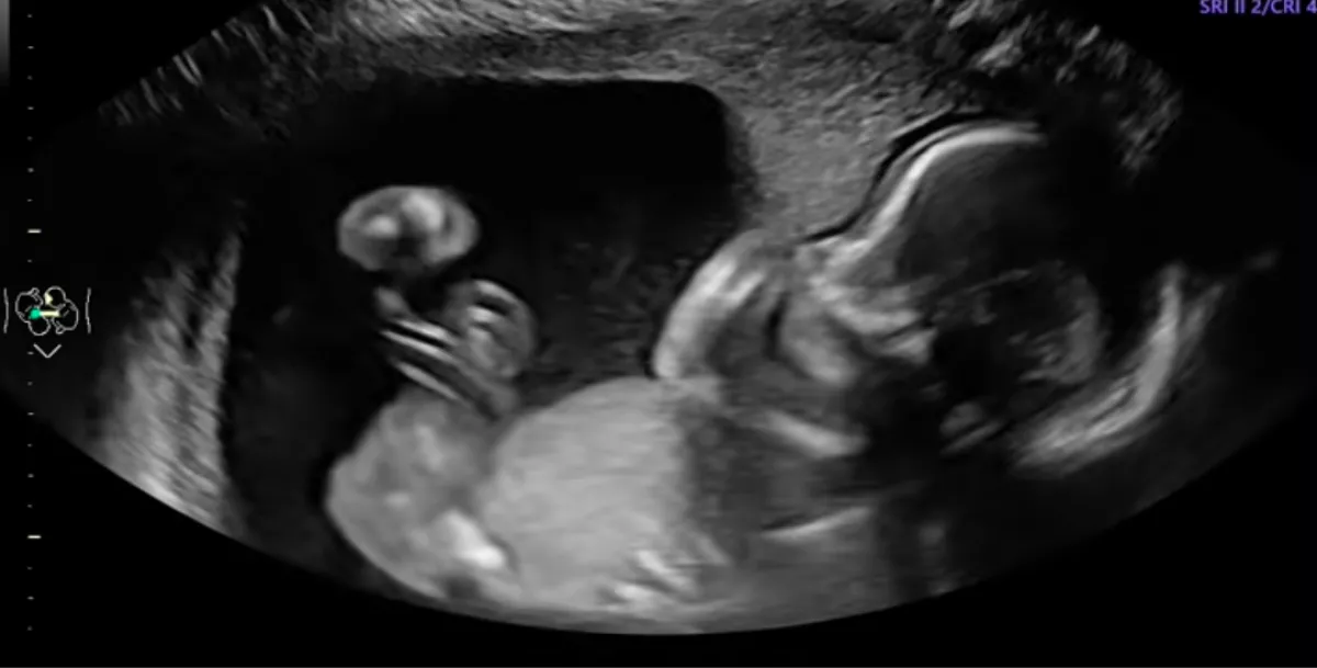 Az ultrahangon figyeli a pár a babáját: amit a pici tesz, lenyűgözi a világot - Videó