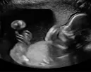 Az ultrahangon figyeli a pár a babáját: amit a pici tesz, lenyűgözi a világot - Videó Az ultrahangon figyeli a pár a babáját: amit a pici tesz, lenyűgözi a világot - Videó