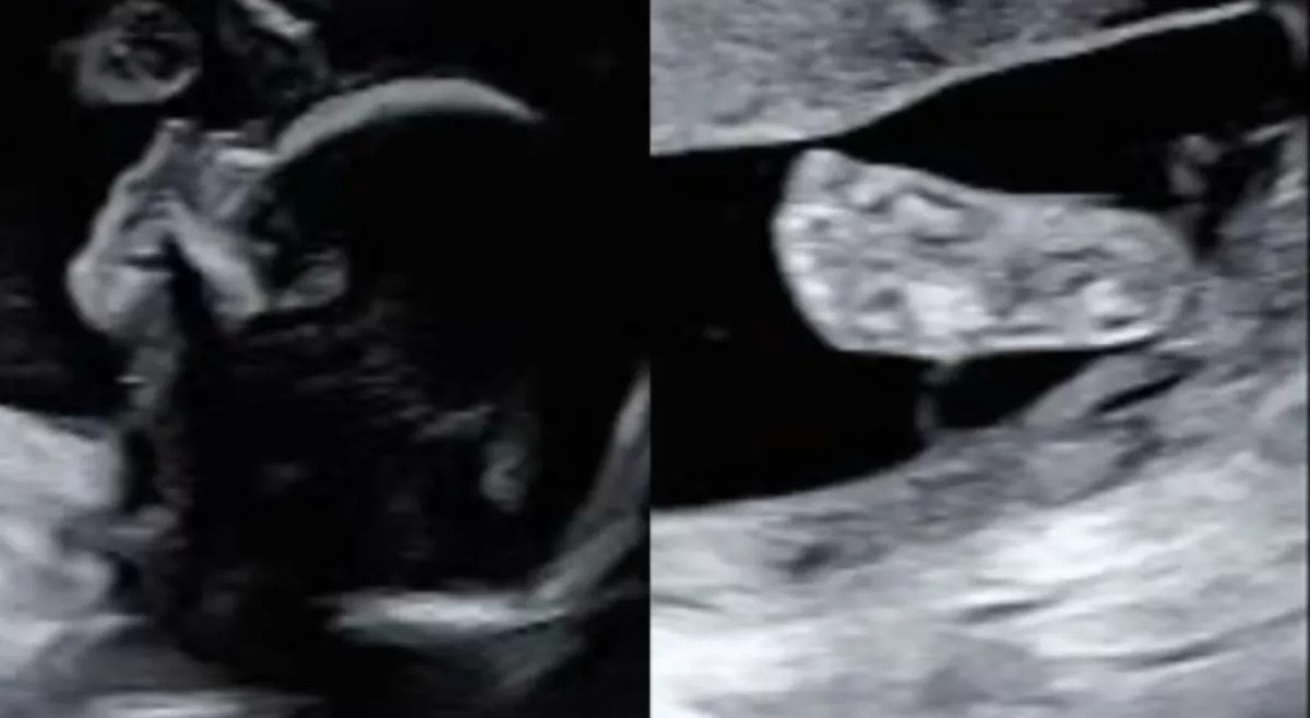 Ultrahangra megy a kismama: amikor később megnézi a képet, elakad a szava - Fotók