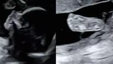 Ultrahangra megy a kismama: amikor később megnézi a képet, elakad a szava - Fotók