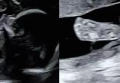 Ultrahangra megy a kismama: amikor később megnézi a képet, elakad a szava - Fotók