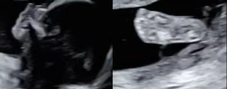 Ultrahangra megy a kismama: amikor később megnézi a képet, elakad a szava - Fotók