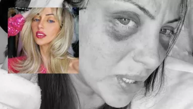 Holtan találtak egy 31 éves influenszert: Barbara 27 plasztikai műtétjével lett netes celeb - Fotók