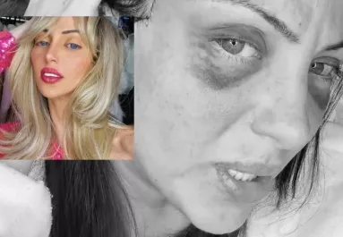 Holtan találtak egy 31 éves influenszert: Barbara 27 plasztikai műtétjével lett netes celeb - Fotók