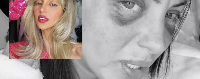 Holtan találtak egy 31 éves influenszert: Barbara 27 plasztikai műtétjével lett netes celeb - Fotók