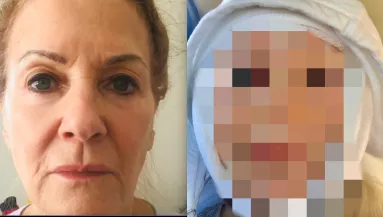 Újra fiatalnak szeretne tűnni a 70 éves nő: így néz ki az arcplasztika után - Fotók