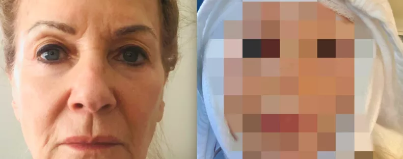 Újra fiatalnak szeretne tűnni a 70 éves nő: így néz ki az arcplasztika után - Fotók